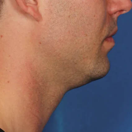 Kybella case #4617