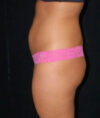 Liposuction case #4664