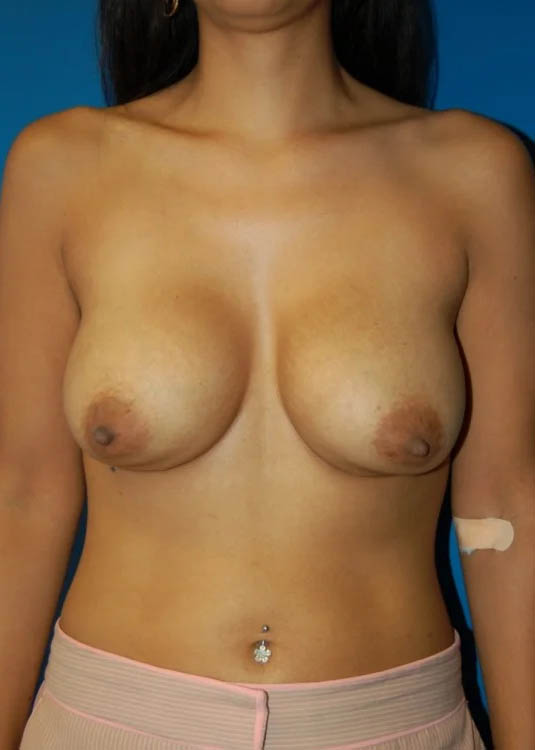 Revision Breast Augmentation with Benelli Lift case #3876