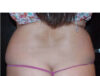 Coolsculpting case #4295
