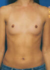 Breast Augmentation case #3620