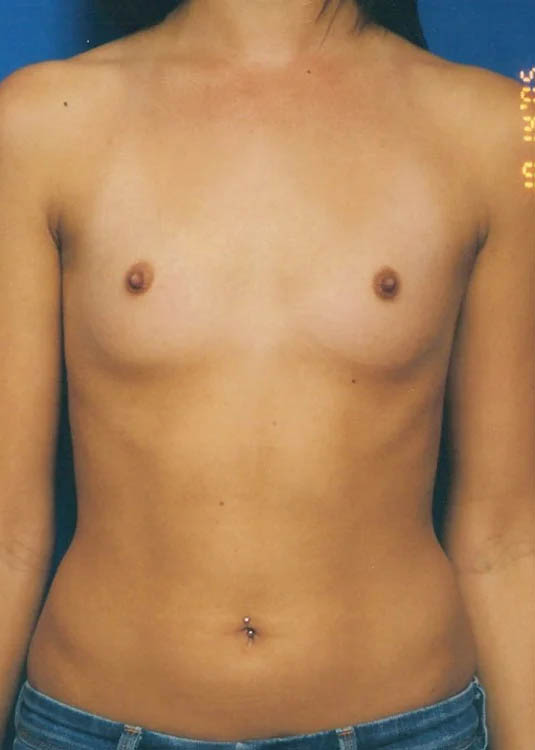 Breast Augmentation case #3620