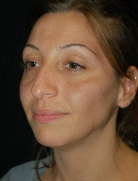 Facial Fat Grafting case #4479