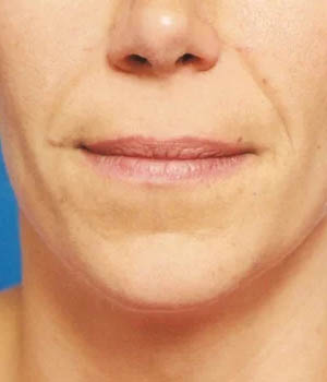 Lip Fillers case #4661