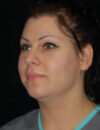 Neck Liposuction case #4925