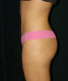 Liposuction case #4664