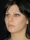 Buccal Fat Removal case #4105