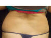 Coolsculpting case #4295