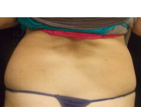Coolsculpting case #4295