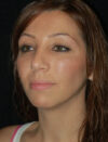 Facial Fat Grafting case #4479