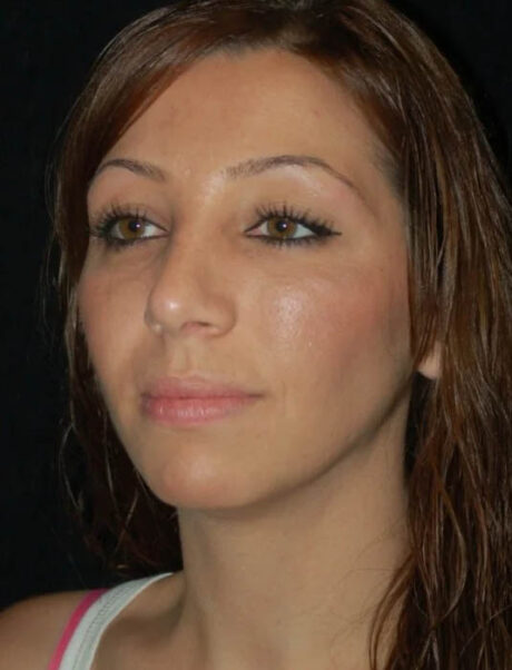 Facial Fat Grafting case #4479