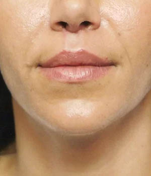 Lip Fillers case #4661