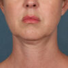 Kybella case #4622