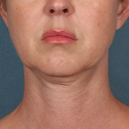 Kybella case #4622