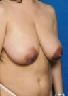 Breast Lift case #3961