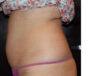 Coolsculpting case #4295