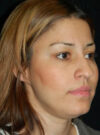Buccal Fat Removal case #4106