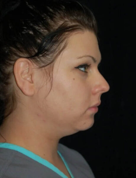 Neck Liposuction case #4925