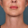 Kybella case #4622