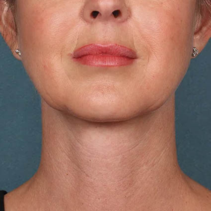 Kybella case #4622