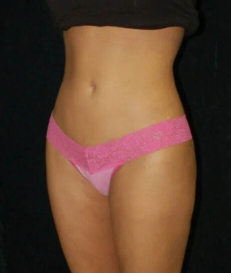 Liposuction case #4664