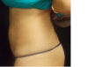 Coolsculpting case #4295