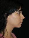 Neck Liposuction case #4925