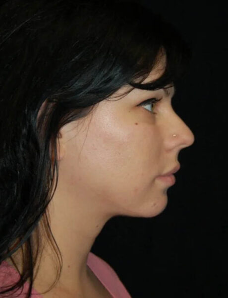 Neck Liposuction case #4925
