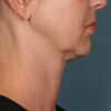 Kybella case #4622