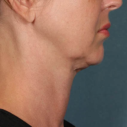 Kybella case #4622