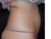 Coolsculpting case #4295