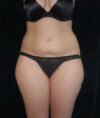 Liposuction case #4671