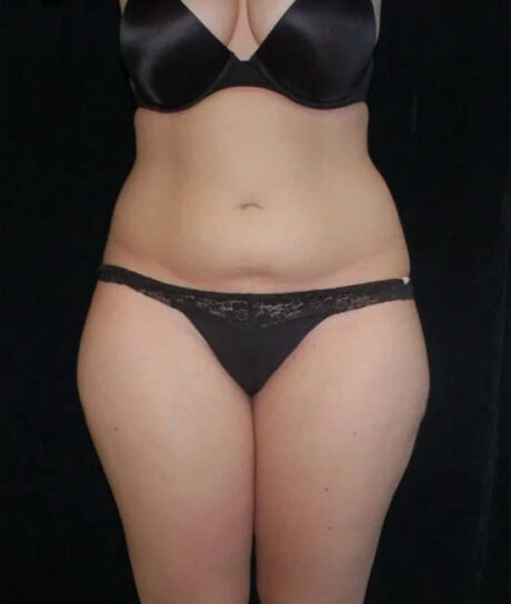 Liposuction case #4671