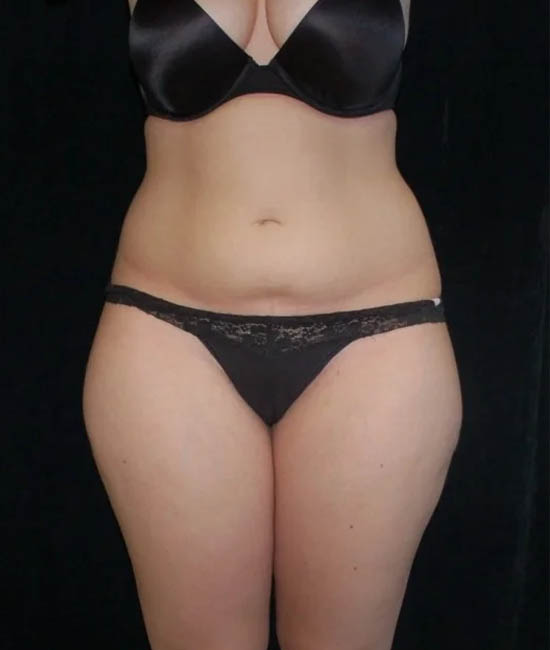 Liposuction case #4671