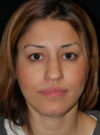 Buccal Fat Removal case #4106