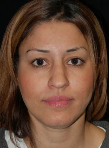 Buccal Fat Removal case #4106