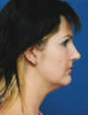Neck Liposuction case #4930