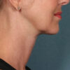 Kybella case #4622