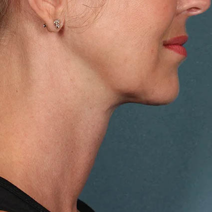 Kybella case #4622