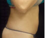 Coolsculpting case #4295