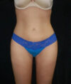 Liposuction case #4671