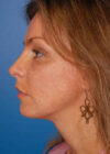 Chin Implant case #4183