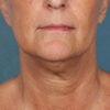 Kybella case #4629