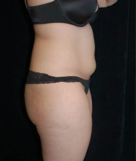 Liposuction case #4671