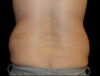 Coolsculpting case #4304
