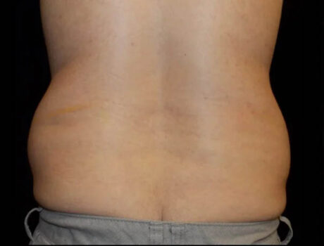 Coolsculpting case #4304