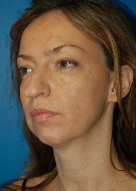 Chin Implant case #4183
