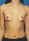 Breast Augmentation case #3625