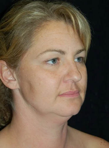 Buccal Fat Removal case #4111