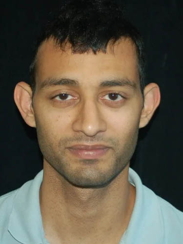 Otoplasty case #5020